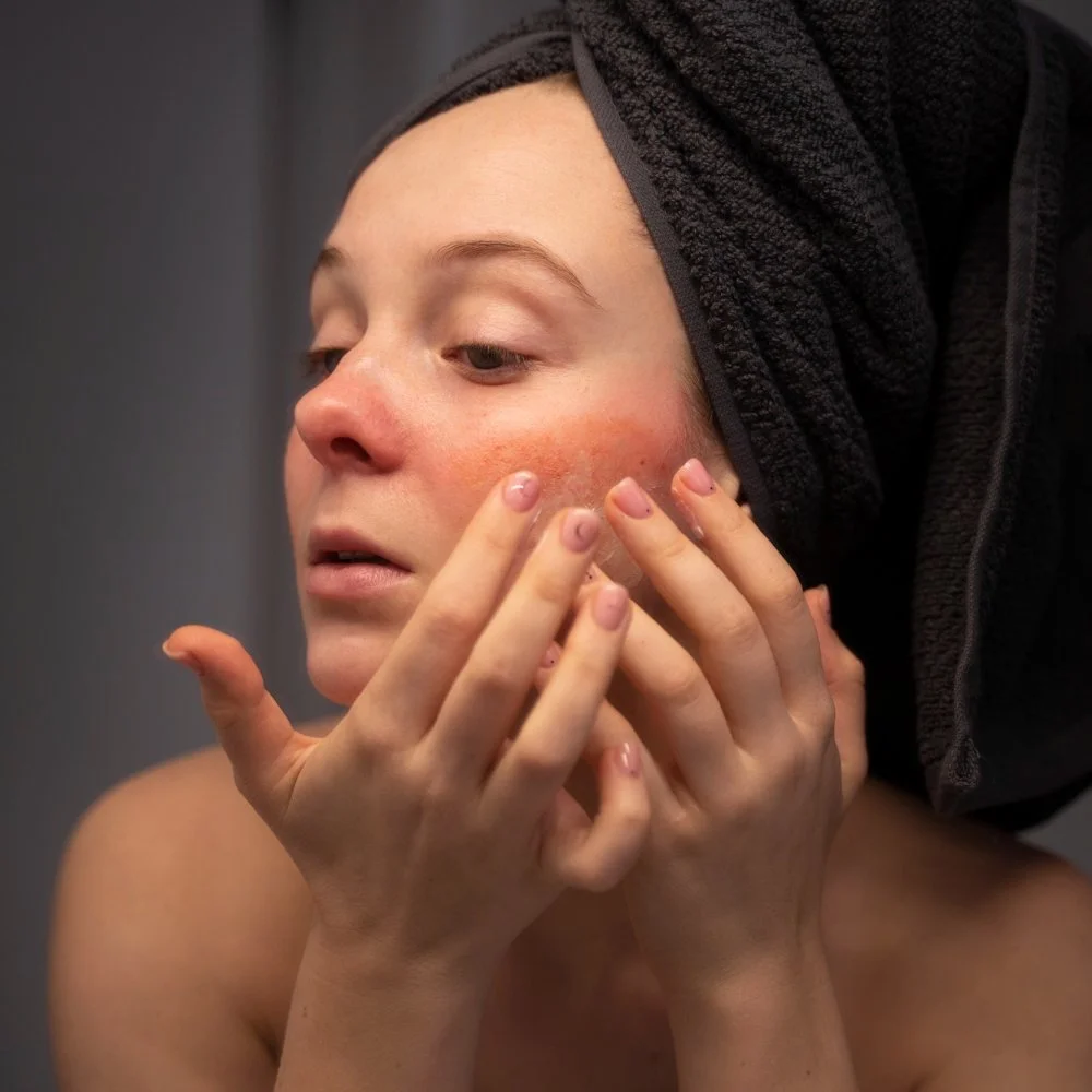 mergina liečia savo paraudusią veido odą